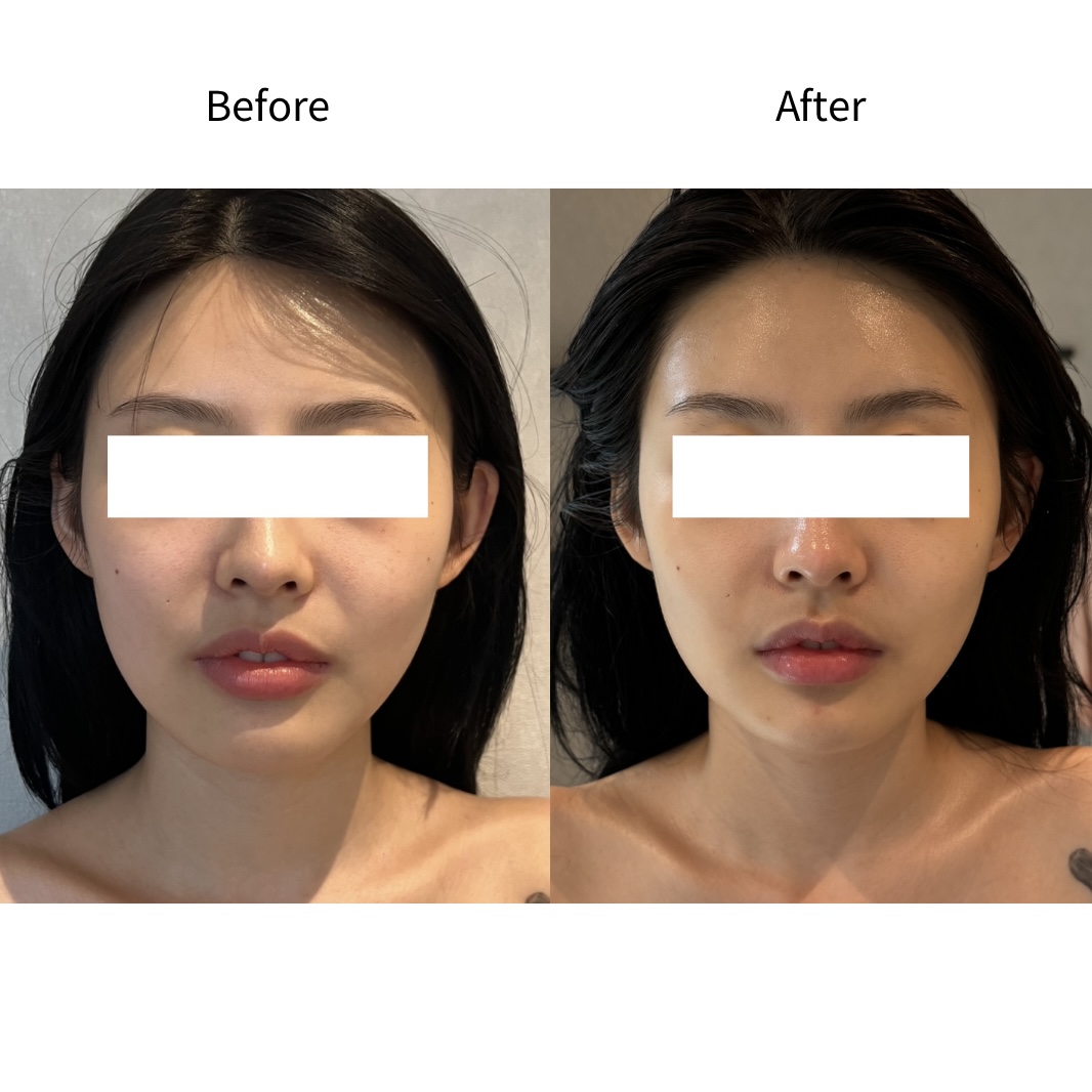 얼굴라인 대칭 균형 Before & After