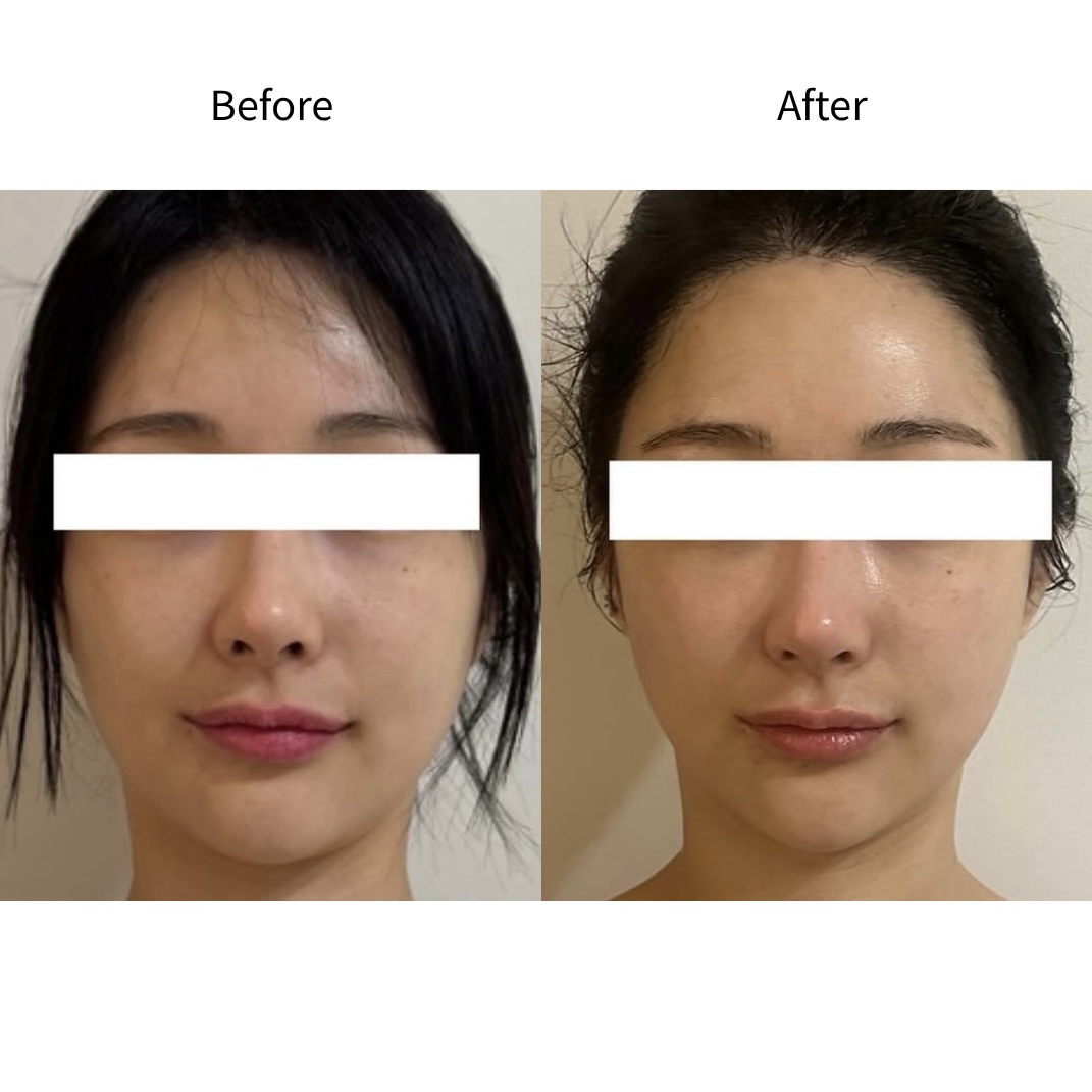 얼굴 붓기 대칭 균형 Before & After
